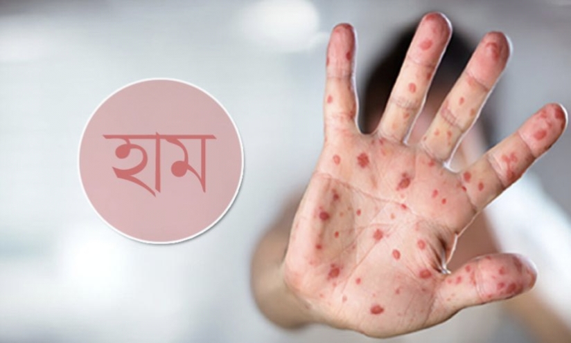 হাম ও উপসর্গে আরও ১০ শিশুর মৃত্যু